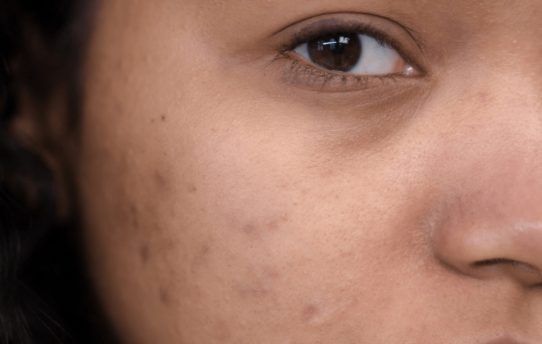 Banishing Acne Scars Naturally: Your Journey to a Radiant Complexion