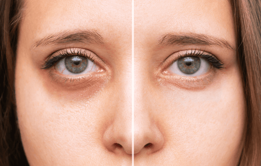 Goodbye Panda Eyes: Natural Hacks for Banishing Dark Circles